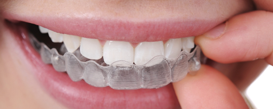 3 métodos alternativos para Clareamento Dental
