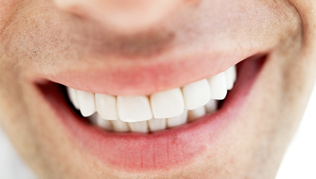 9 sinais de que você precisa usar Aparelho Dentário