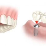Implantes dentários podem mudar a vida das pessoas